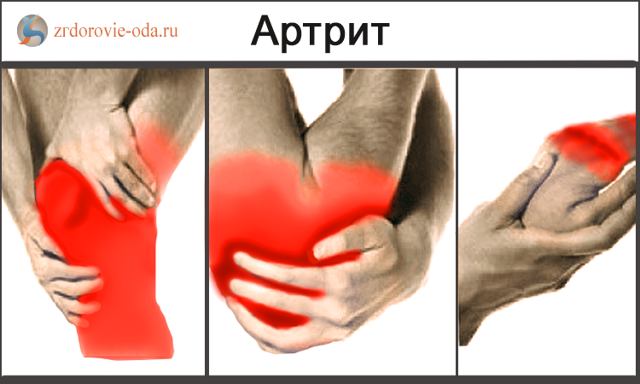 Артрит и артроз в чем. Разница артрита от артроза. Отличия остеоартроза от артрита.