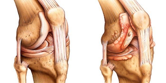 Артрит коленного сустава — симптомы и лечение, упражнения, диета