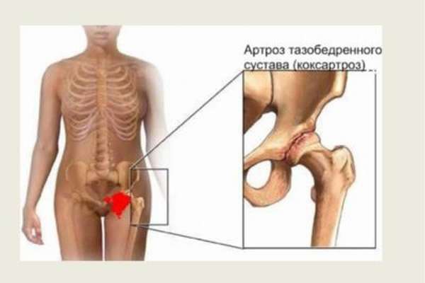 Артроз деформирующий: причины, симптомы, лечение