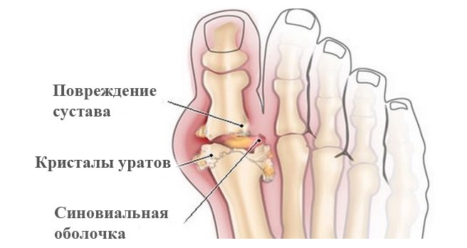Артроз деформирующий: причины, симптомы, лечение