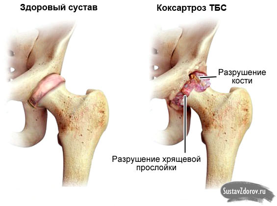 Артроз тазобедренного сустава &mdash; симптомы и лечение коксартроза