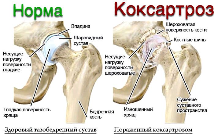 Артроз тазобедренного сустава &mdash; симптомы и лечение коксартроза