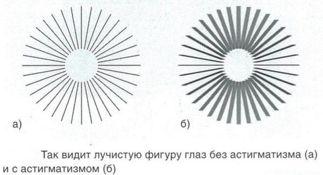 Астигматизм: лечение, степени астигматизма у детей и взрослых, формы астигматизма, очки и линзы при астигматизме.