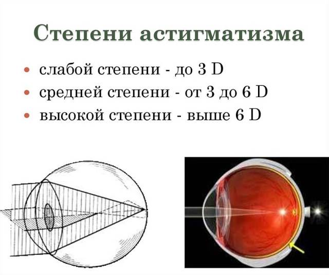 Астигматизм: лечение, степени астигматизма у детей и взрослых, формы астигматизма, очки и линзы при астигматизме.