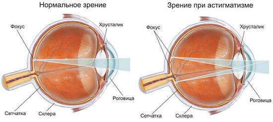 Астигматизм: проявления и методы коррекции
