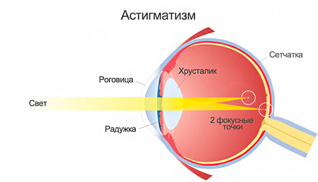 Астигматизм: проявления и методы коррекции