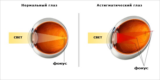 Астигматизм: проявления и методы коррекции