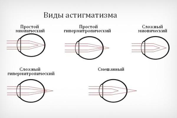 Астигматизм у детей: симптомы, лечение, профилактика