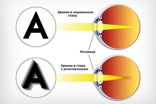 Астигматизм у детей: симптомы, лечение, профилактика