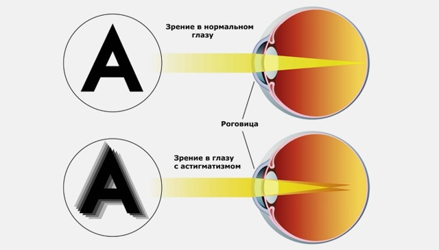 Астигматизм у детей: симптомы, лечение, профилактика