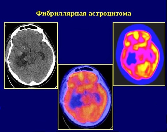 Астроцитома головного мозга анапластическая, фибриллярная, пилоцитарная, пилоидная, диффузная