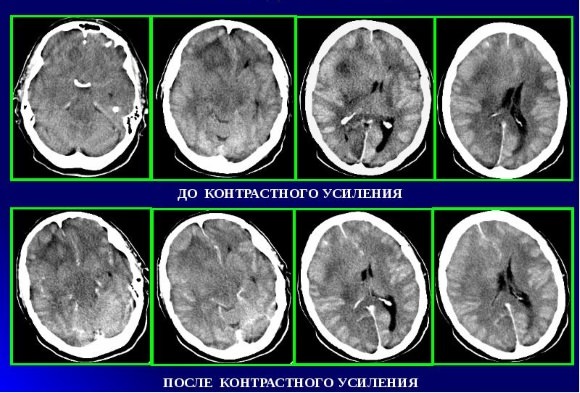 Астроцитома головного мозга анапластическая, фибриллярная, пилоцитарная, пилоидная, диффузная