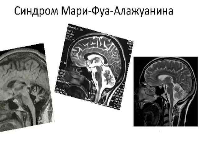 Атаксия мозжечковая, вестибулярная, телеангиэктазия и статическая, поздняя наследственная пьера мари