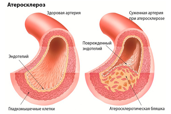 Атеросклероз: симптомы, причины, способы диагностики и профилактики, медикаментозные методы латеросклероз: симптомы, причины, способы диагностики и профилактики, медикаментозные методы лечения атеросклероза и средства народной медицины