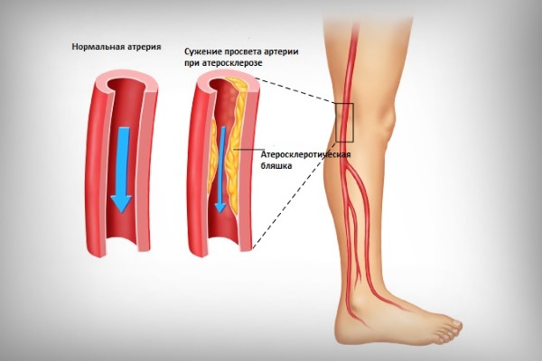 Атеросклероз сосудов нижних конечностей — симптомы, лечение, причины