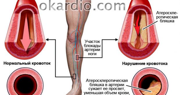 Атеросклероз сосудов нижних конечностей — симптомы, лечение, причины