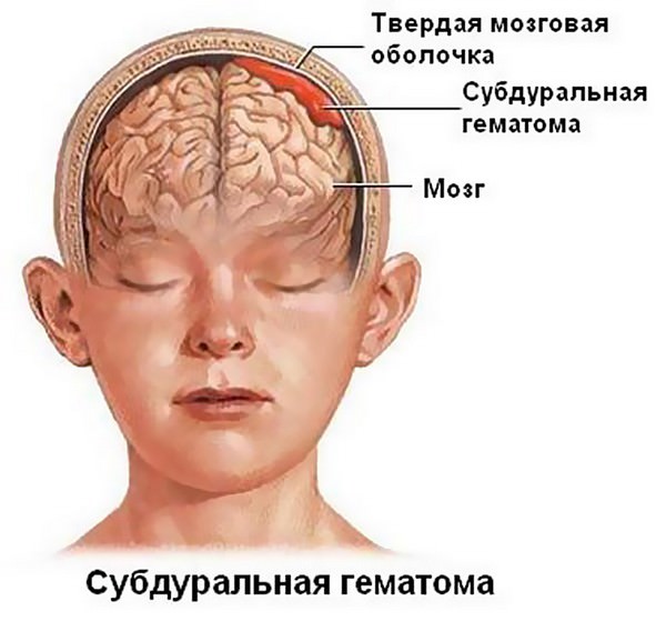 Атоническая кома по степени, шансы на выживание, выход из поверхностной и глубокой