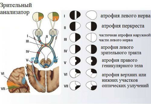 Атрофия зрительного нерва, лечение народными средствами, частичная и нисходящая