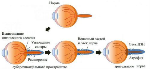 Атрофия зрительного нерва, лечение народными средствами, частичная и нисходящая