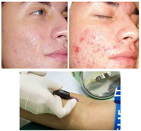 Аутогемотерапия: показания, отзыв, схема проведения