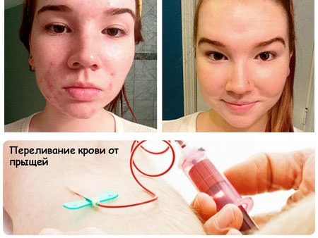 Аутогемотерапия: показания, отзыв, схема проведения