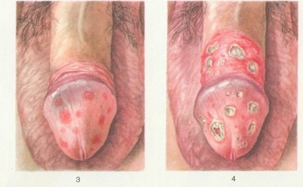 Баланопостит – симптомы баланопостита у детей и мужчин, лечение баланопостита в домашних условиях