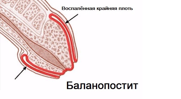 Баланопостит – симптомы баланопостита у детей и мужчин, лечение баланопостита в домашних условиях