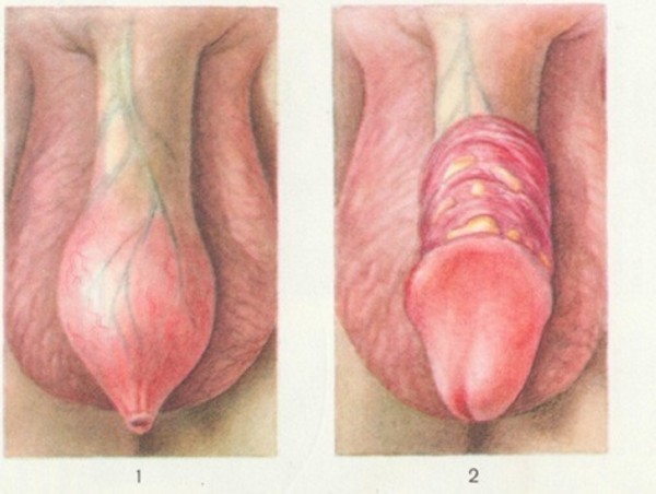 Баланопостит – симптомы баланопостита у детей и мужчин, лечение баланопостита в домашних условиях