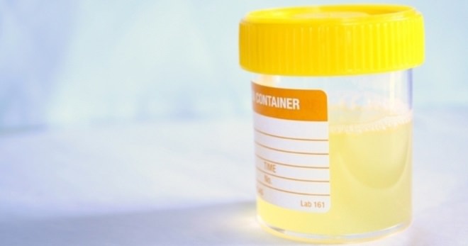 Белок в моче &mdash; что это значит, причины появления, что делать