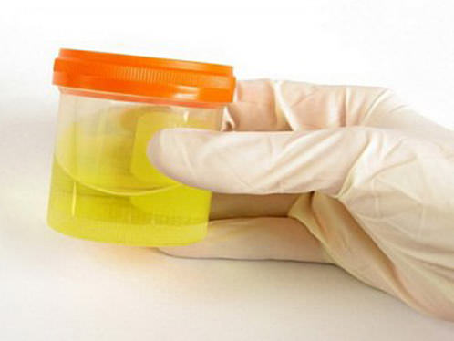 Белок в моче &mdash; что это значит, причины появления, что делать