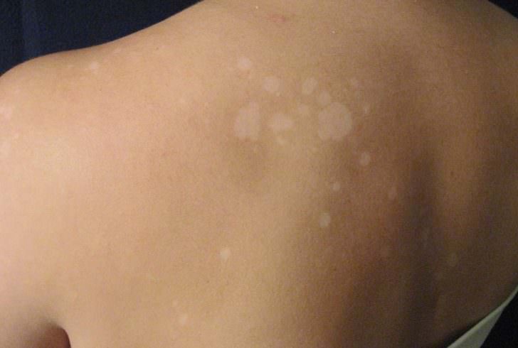 Белые пятна на коже: почему, что делать
