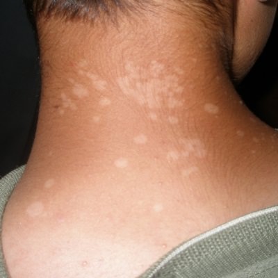 Белые пятна на коже: почему, что делать