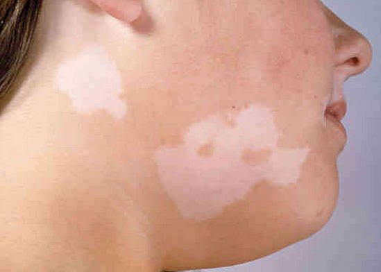 Белые пятна на коже: почему, что делать