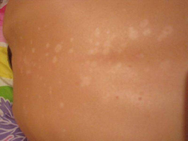 Белые пятна на коже: почему, что делать