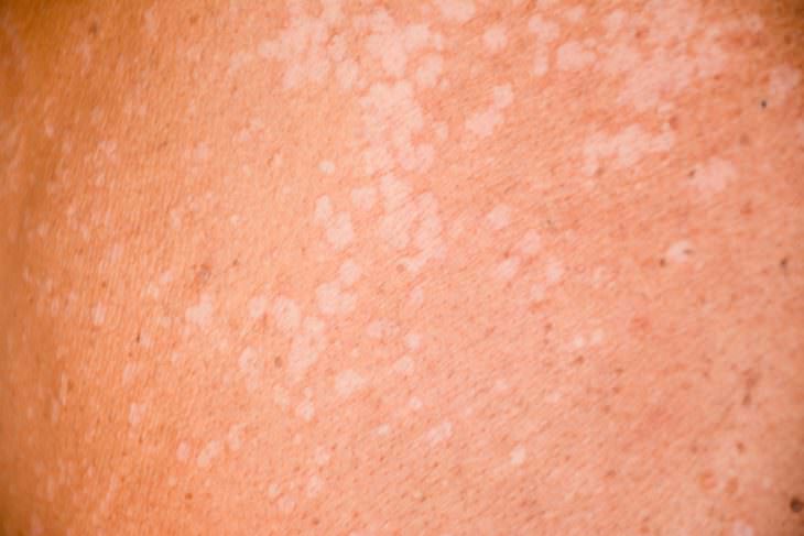 Белые пятна на коже: почему, что делать