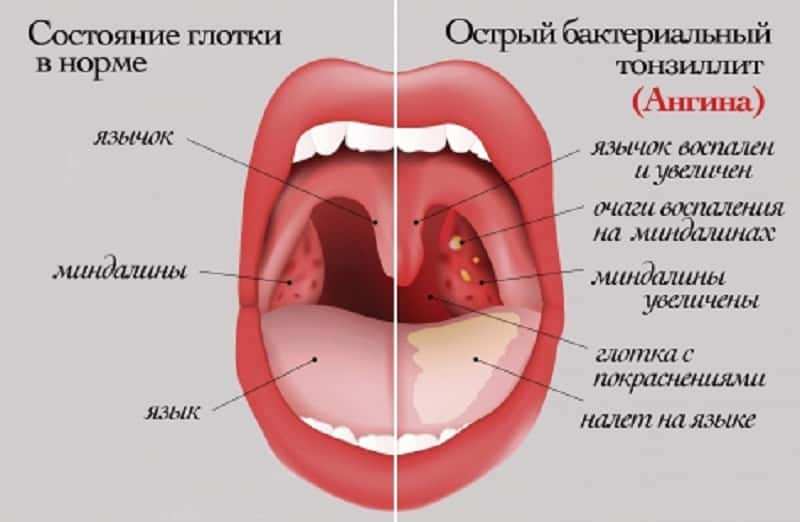 Белый налет на миндалинах (гландах). у ребенка и взрослого. как лечить?