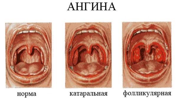 Белый налет на миндалинах (гландах). у ребенка и взрослого. как лечить?