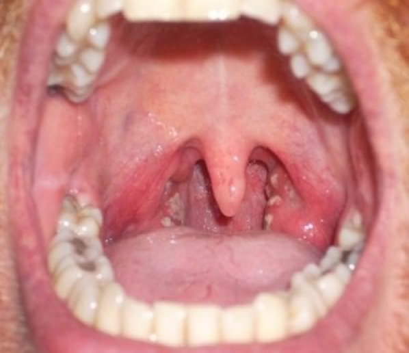 Белый налет в горле: у ребенка и взрослого. причины и лечение