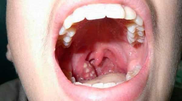 Белый налет в горле: у ребенка и взрослого. причины и лечение