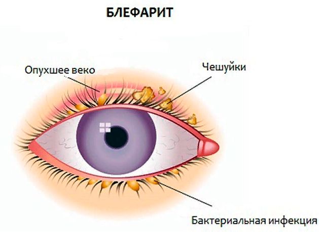 Блефарит &mdash; что это такое, причины, симптомы, лечение, код мкб