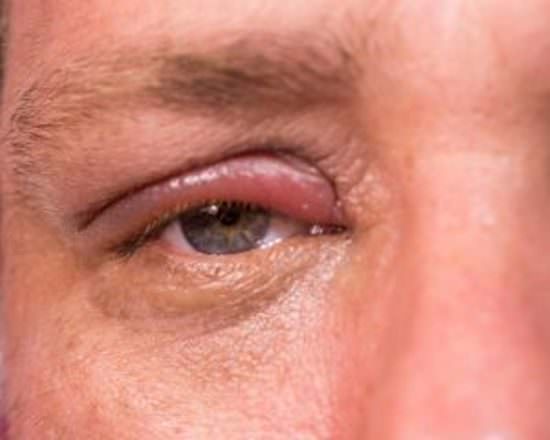 Блефарит &mdash; что это такое, причины, симптомы, лечение, код мкб