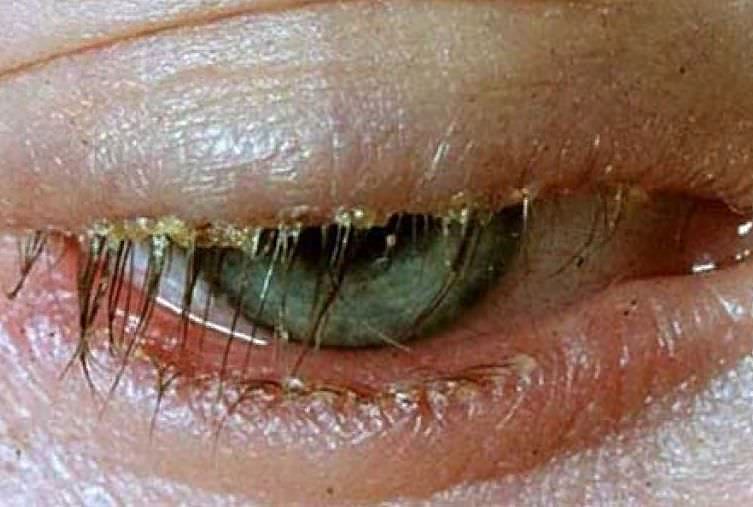 Блефарит &mdash; что это такое, причины, симптомы, лечение, код мкб