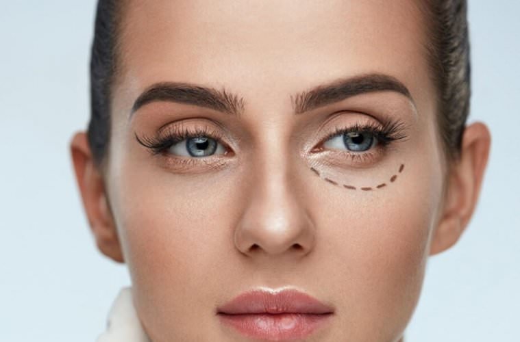 Блефаропластика. отзывы прооперированных. фото, плюсы и минусы пластики нижних, верхних век, осложнения, последствия, швы, реабилитация. лазерная, трансконъюктивальная, круговая, инъекционная. стоит ли делать?