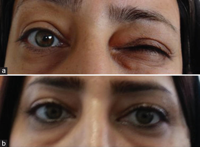 Блефароспазм глаз, причины, симптомы и лечение