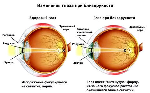 Близорукость – степени, лечение, коррекция миопии, упражнения для глаз