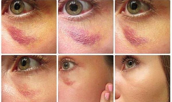 Бодяга для лица от синяков, прыщей, пигментных пятен. инструкция по применению, рецепты, отзывы, фото до и после