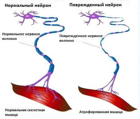 Боковой амиотрофический склероз, болезнь шарко, симптомы и причины синдрома