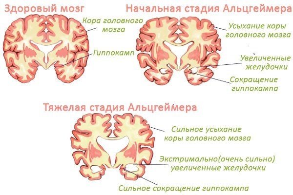 Болезнь альцгеймера, лечение в домашних условиях