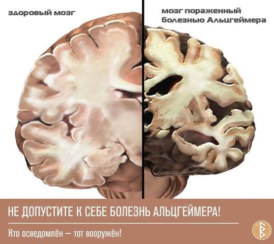 Болезнь альцгеймера, лечение в домашних условиях