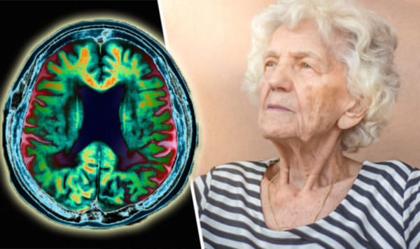 Болезнь альцгеймера последняя стадия: сколько живут, как протекает
